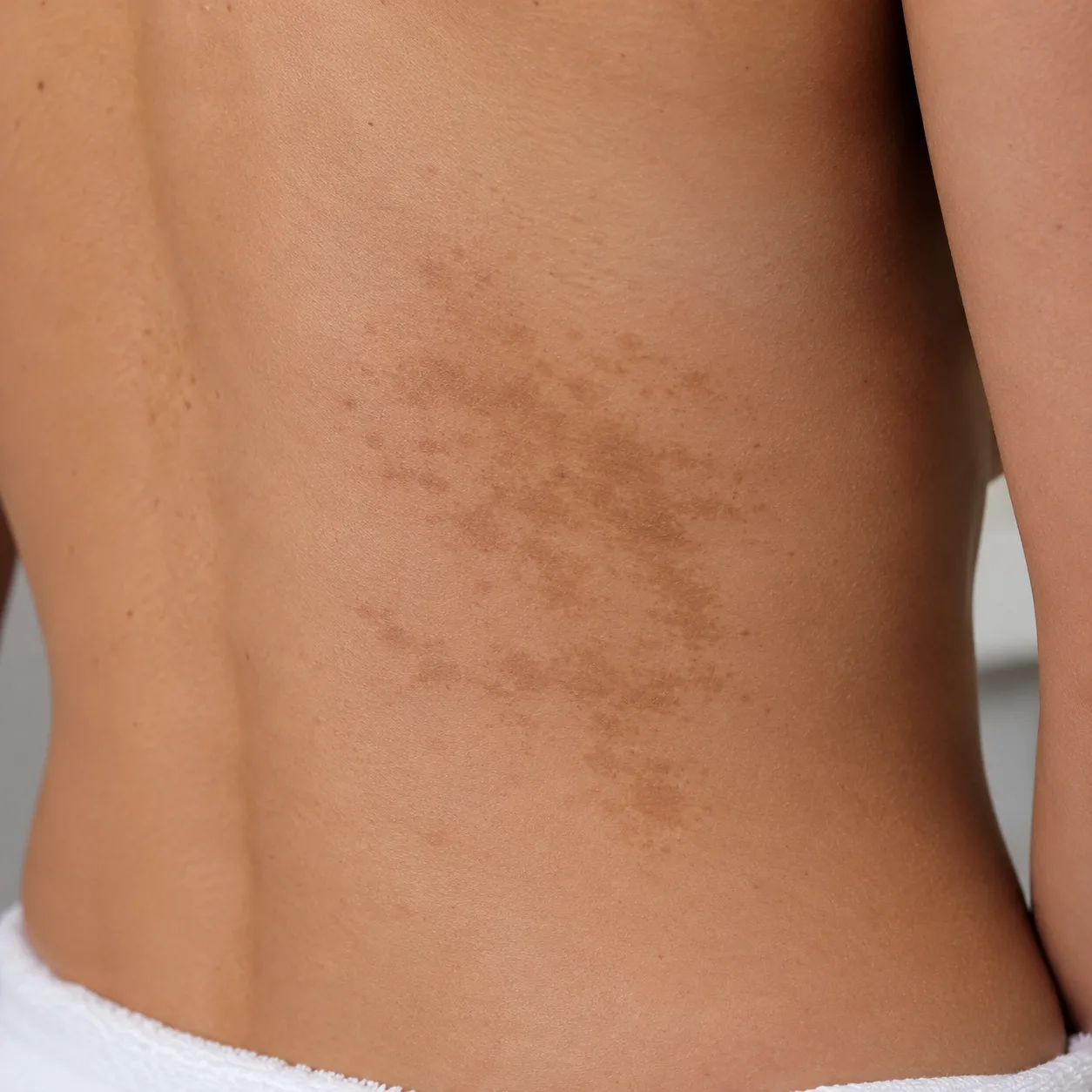 mmagine rappresentativa di capillari superficiali e piccole lesioni vascolari della gamba, trattabili con tecnologie laser selettive.