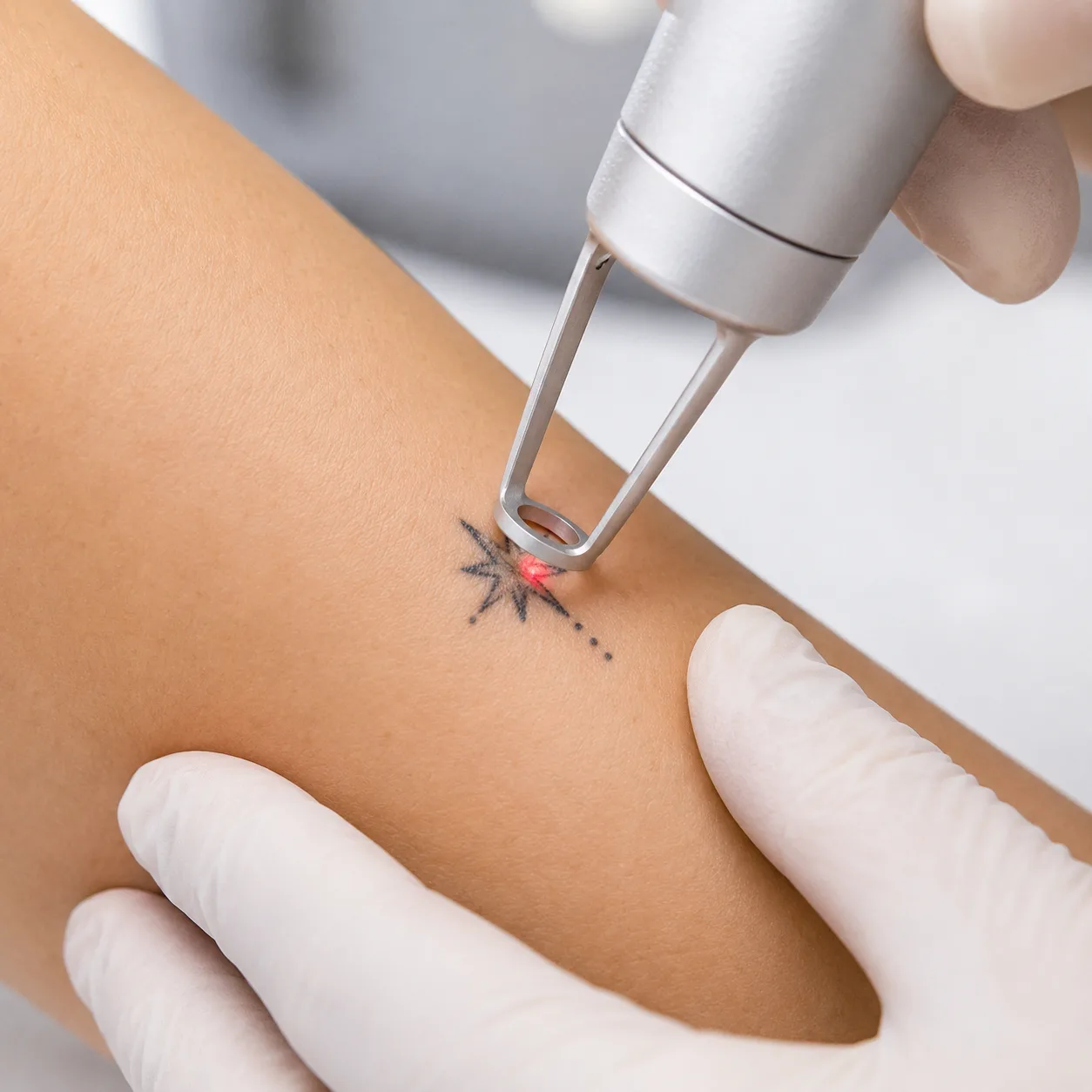 Rimozione laser di piccolo tatuaggio su pelle con manipolo medicale in studio estetico